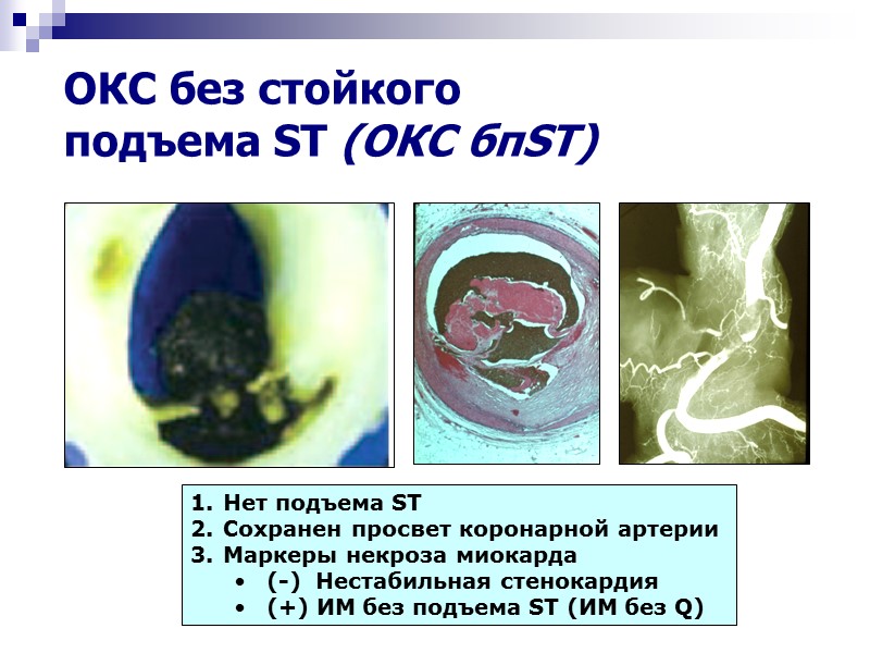 ОКС без стойкого  подъема ST (ОКС бпST) Нет подъема ST Сохранен просвет коронарной